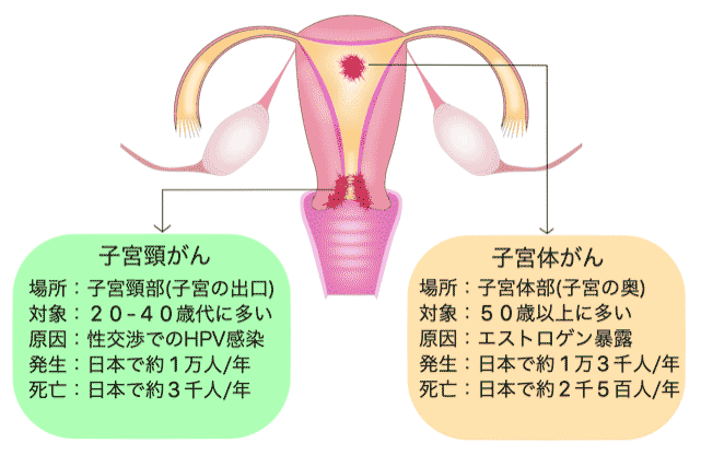 子宮頸がんと子宮体がん